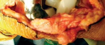 Illustration 39 for Precision Soft Tissue Balancing in Revision: Avoid TKA Pitfalls