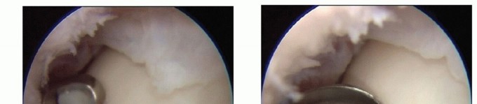 Illustration 6 for Restore Damaged Cartilage with Autologous Chondrocyte Transplantation