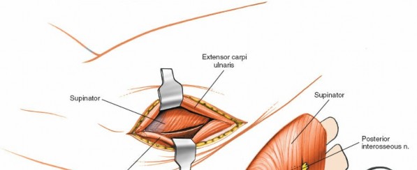 Illustration 95 for Mastering Elbow Approaches: Applied Surgical Anatomy for Precision