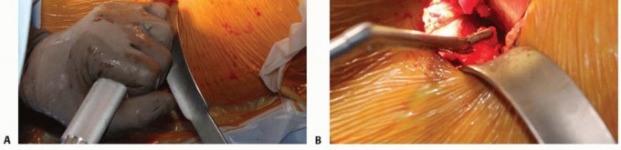 Illustration 45 for Anterior FAI Relief: Mini-Open Anterior Approach Explained