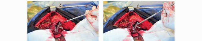 Illustration 38 for Cement in Cement Revision: Simplifying Complex Hip Revisions