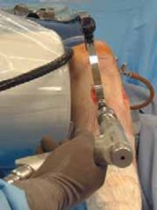 Illustration 9 for Cruciate Ligament Repair: Definitive Guide to Treatment & Recovery