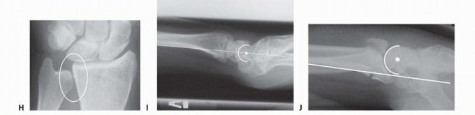 Illustration 13 for Fragment-Specific Fixation: Restore Carpal Facet Horizon