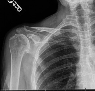 Illustration 22 for Right Shoulder Pain? Avoid This Common X-ray Mistake.