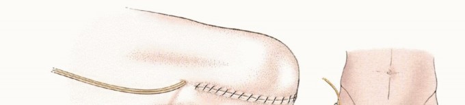 Illustration 22 for Mastering Above-Knee Amputation: Essential Surgical Insights