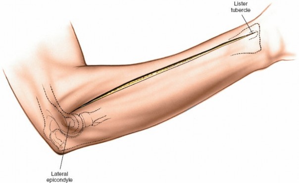 Illustration 3 for Posterior Radius: Expert Tips for Brevis and the Extensor Side
