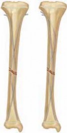 Illustration 15 for Pediatric Tibial Fractures: Avoid Mistakes, Ensure Optimal Healing