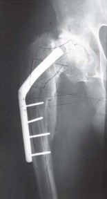 Illustration 5 for THA for patients with proximal femoral deformity: Practical solutions