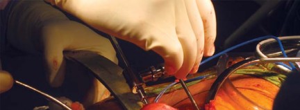 Illustration 46 for Metal on Metal Resurfacing: Enhanced Posterior Soft Tissue Repair