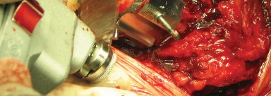 Illustration 46 for Figure Hip Resurfacing: Who Benefits and Who Should Avoid It?