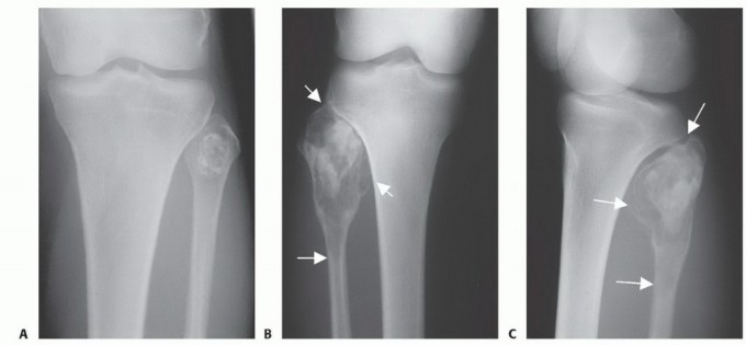 Illustration 9 for Beyond Amputation: The Type I Resection in Fibular Tumor Surgery