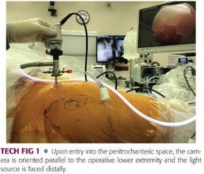 Illustration 108 for Periarticular Arthroscopy: Addressing Medius & Minimus Tears