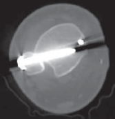 Illustration 40 for Optimal Fixation of the Ankle: Open Reduction & Internal Fixation