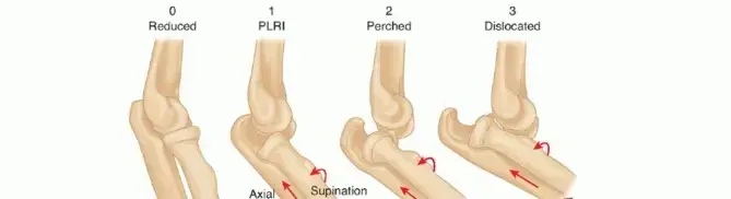 الدليل الشامل لخلع الكوع: الأسباب، الأعراض، العلاج، والتعافي الكامل مع الأستاذ الدكتور محمد هطيف