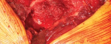 Illustration 8 for The Modified Hardinge Approach: Key Surgical Insights