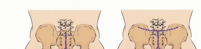 Illustration 22 for Sacral Tumor Surgery: Safeguarding Bowel & Bladder Control