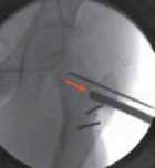Illustration 17 for Increased Femoral Anteversion: A Proximal Femoral Rotational Osteotomy
