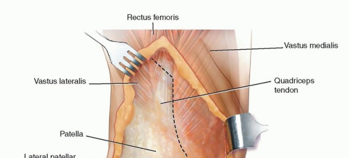 Illustration 12 for Correcting Stiffness in Revision TKA: Achieve Appropriate External Rotation