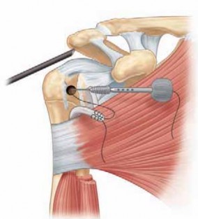 Illustration 10 for Resolve Long Head Biceps Pain: Advanced Arthroscopic Treatment