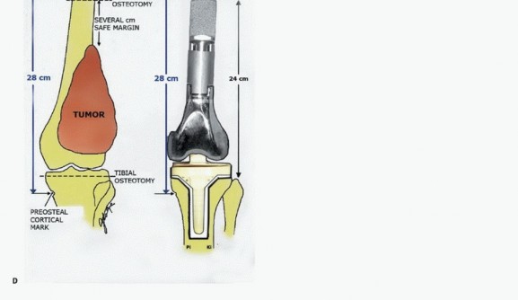 Illustration 7 for Advanced Distal Femoral Resections: Limb-Sparing Outcomes & Techniques