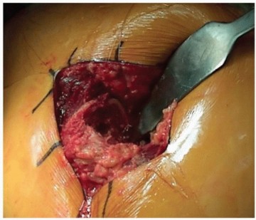 Illustration 7 for Unlock Precision: The Direct Lateral Approach for THA