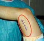 Illustration 4 for Unlocking Mobility: Distal Lengthening for Lateral Hamstring Muscle