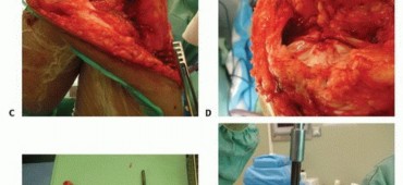 Illustration 8 for Expandable Prostheses: Understanding Infection Risk for Young Patients
