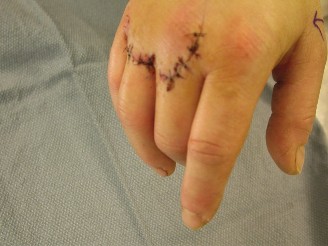 Uncovering Extensor Tendon Lacerations: A Case of Hand Dysfunction
