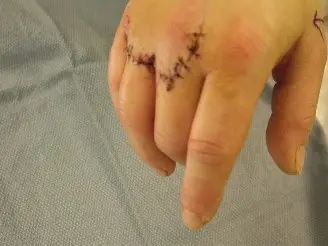 صورة توضيحية لـ تمزق وتر الأصبع الباسط المشترك في اليد: دليلك الشامل للتشخيص والعلاج والتعافي