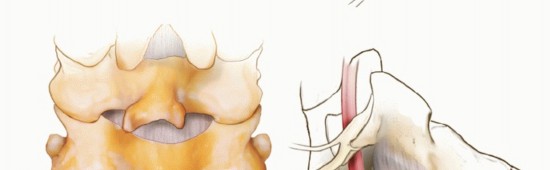 Illustration 21 for Achieve Stability: Posterior Cervical Lateral Mass Screw Fusion