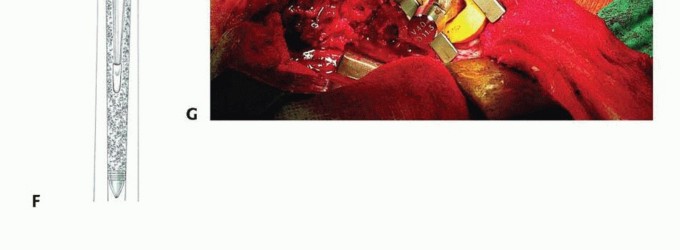 Illustration 29 for Exeter Hip Unit: Mastering Impaction Allografting for Femoral Bone Loss