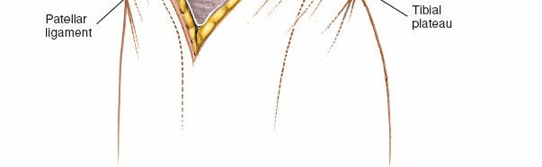 Illustration 43 for Mastering Knee Approaches: Spotlight on Superficial Medial Ligament