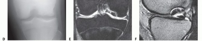 Illustration 16 for Dissecans of the Knee: What's the Difference – OCD vs. AVN?