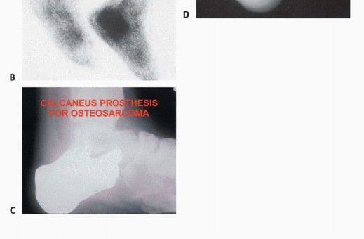 Illustration 14 for Treating Tumors of the Foot: Optimizing Amputation & Resection