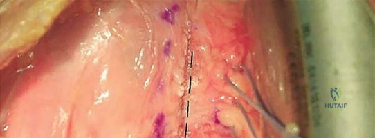 صورة توضيحية لـ إصلاح الأعصاب المقطوعة وزراعة العصب: استعادة الحياة لحركتك وإحساسك مع الأستاذ الدكتور محمد هطيف