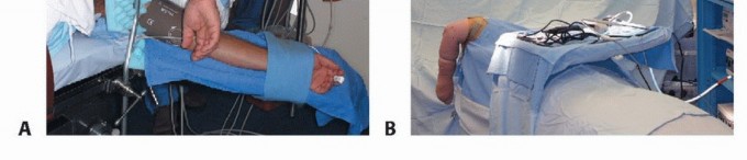 Arthroscopic Debridement for Elbow: Lasting Relief from Joint Pain