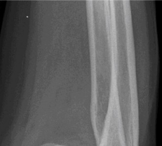 Elbow Dislocation Cases: Diagnose, Treat & Manage Effectively