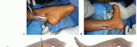 Illustration 40 for How Achilles Tendon Lengthening Fixes Equinocavovarus Foot