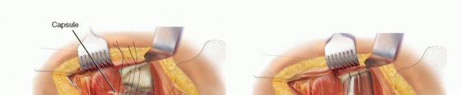 Illustration 53 for Hemiarthroplasty of the Hip: Indications & Types Explained