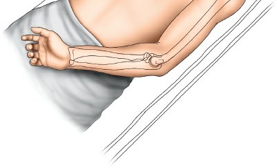 Illustration 2 for Medial Approach to the Distal Humerus: Master Techniques & Avoid Osteotomy