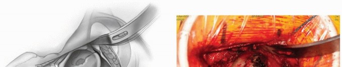 صورة طبية: النهج الأمامي لاستبدال مفصل الورك الكلي: ثورة في جراحة الورك مع الأستاذ الدكتور محمد هطيف في صنعاء