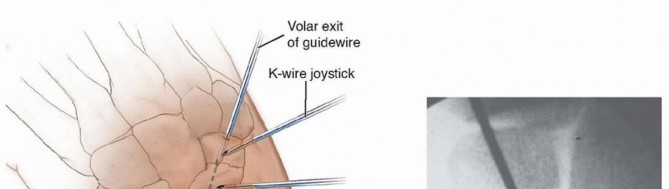 Illustration 7 for Mastering Percutaneous Fixation of Acute Scaphoid Fractures