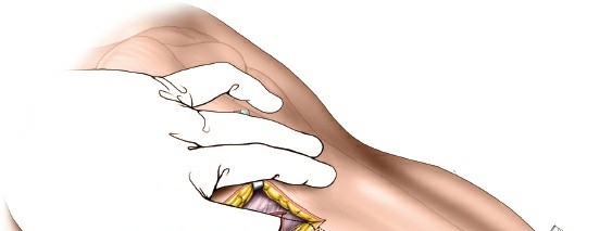 Illustration 55 for Surgical Access: Mastering the Tibia's Surface & Fibula Approaches