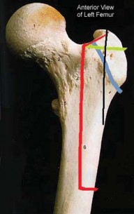 Illustration 2 for Standard Trochanteric Osteotomy: Key to Complex Hip Cases