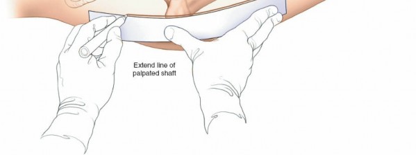 Illustration 67 for Optimal Femoral Approaches: Mastering the Lateral Intermuscular Septum