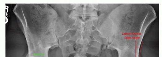 Illustration 3 for Restore Hip Health: Pelvic Osteotomy for Acetabular Dysplasia & CEA of Less