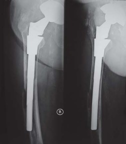 Illustration 75 for S-ROM: Inside the Technique of Modular Implant Design