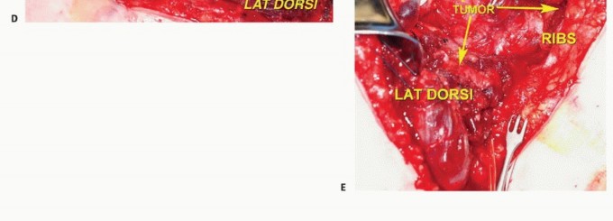 Illustration 21 for Axillary Space Exploration: Surgical Resection of Complex Tumors