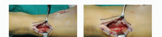 Illustration 43 for Foot Drop Surgery: How a Pin or Drill Elevates Tendon Transfer