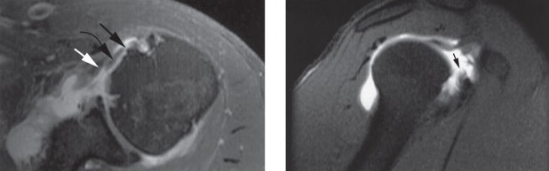 Illustration 2 for Partial-Thickness Rotator Cuff Tears: Repair or Debride?